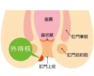 外核痔